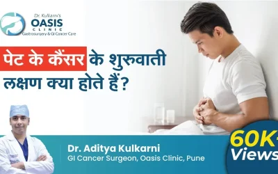 Early Signs & Symptoms of Stomach Cancer