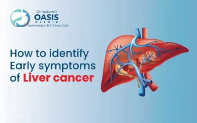 How to Identify Early Symptoms of Liver Cancer