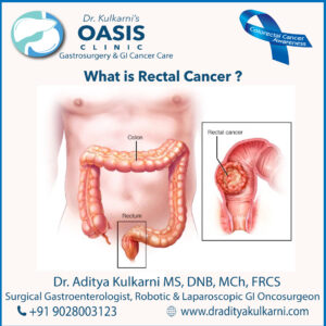 Rectal-Cancer