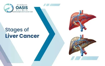 Stages of Liver Cancer