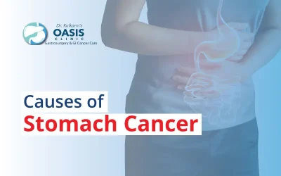 What causes stomach cancer?