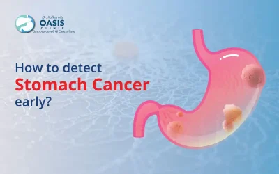How To Detect Stomach Cancer Early?