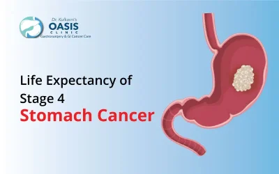 Stage 4 Stomach Cancer Life Expectancy With Treatment