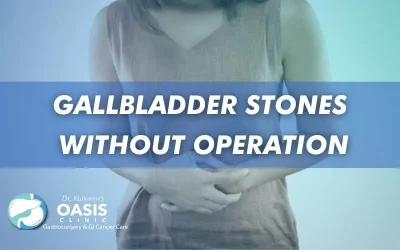 Move Gallbladder Stones Without Operation