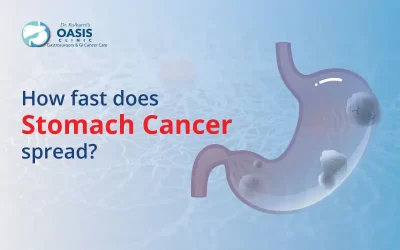 How Fast Does Stomach Cancer Spread?