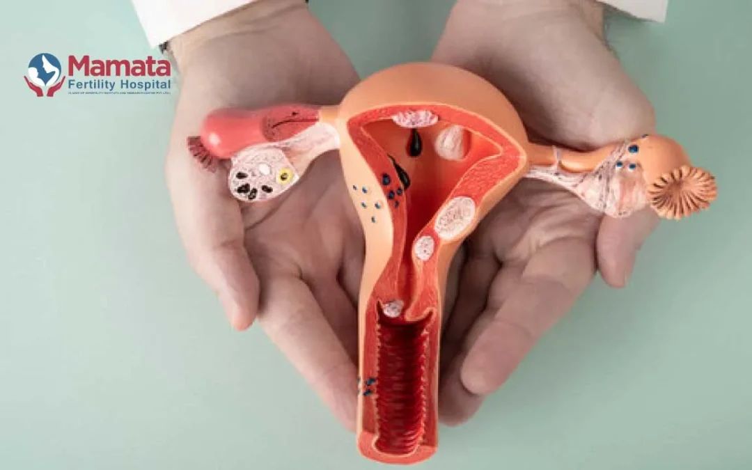 The Difference Between Endometriosis and Adenomyosis