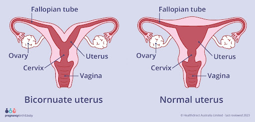 Bicornuate
