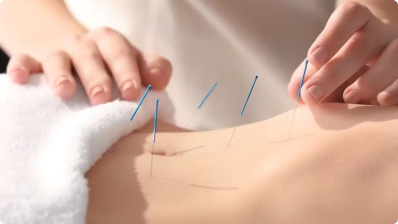 Acupuncture