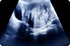 Fibroid Mapping Scan (2D3D)