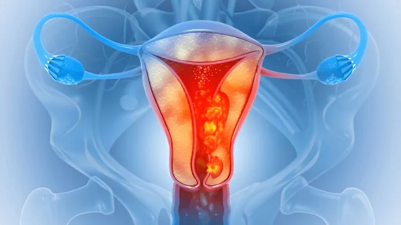 Azoospermia