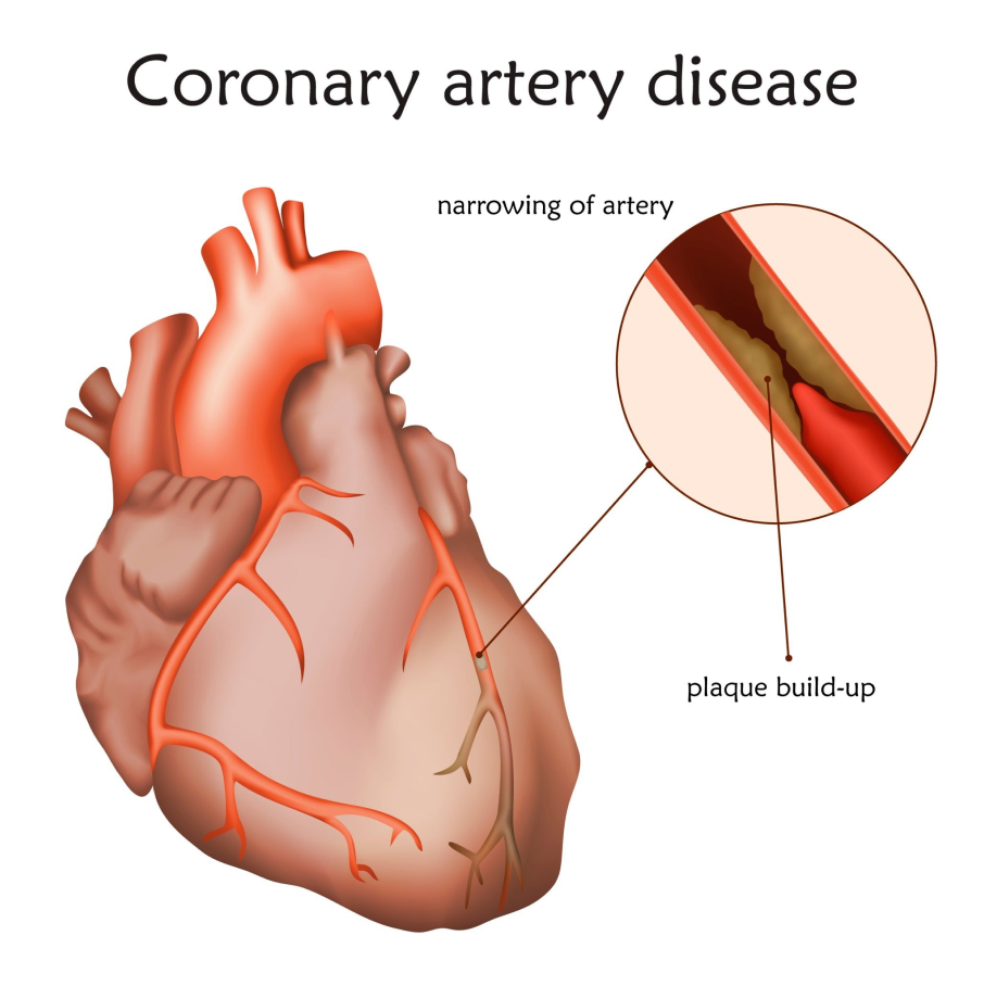 coronary-disease